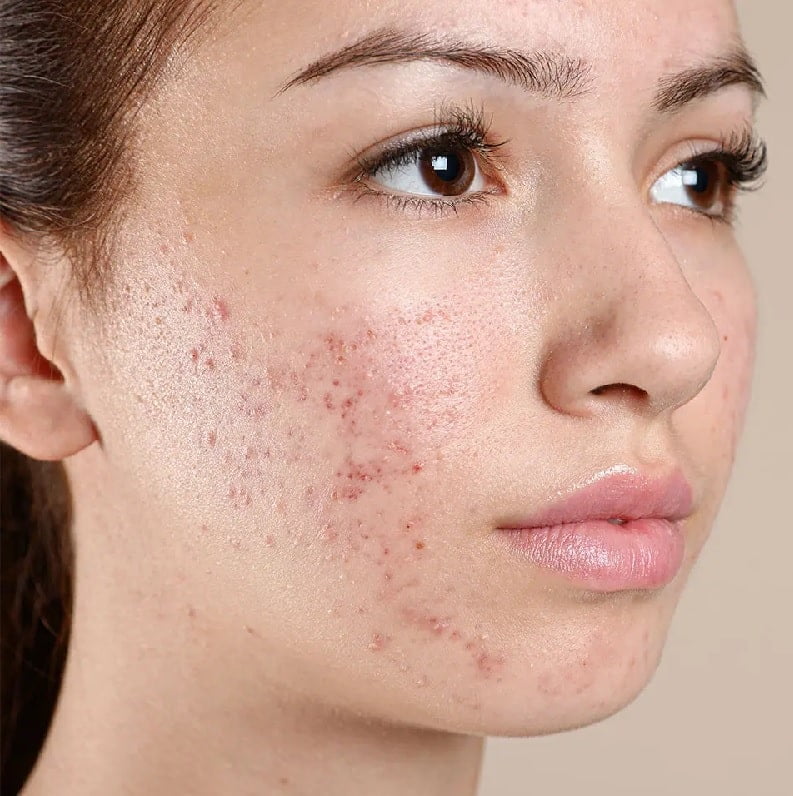 Acne Tablets in Pakistan Regain Your Skin Shine 2025 - Gluta One