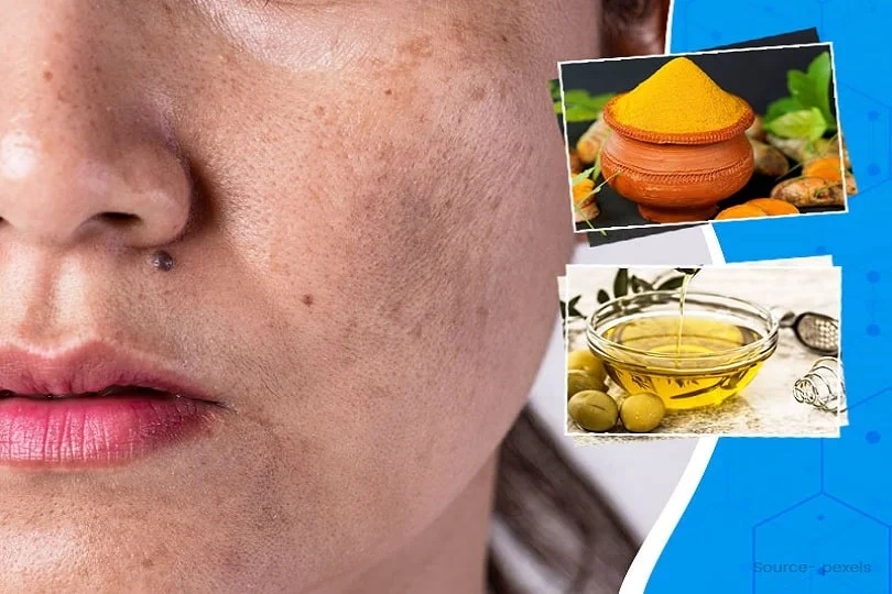 Herbal Remedies for Pigmentation
