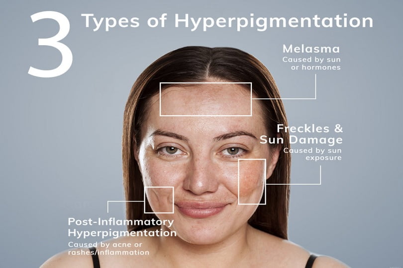 Different Types of Hyperpigmentation