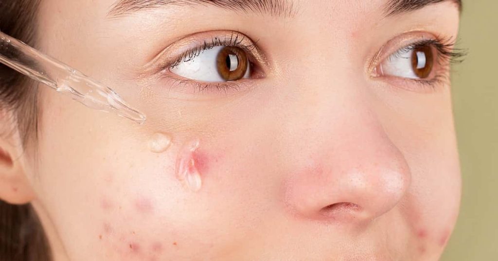 Realistic Expectations and Timeframe for Acne Scar Improvement