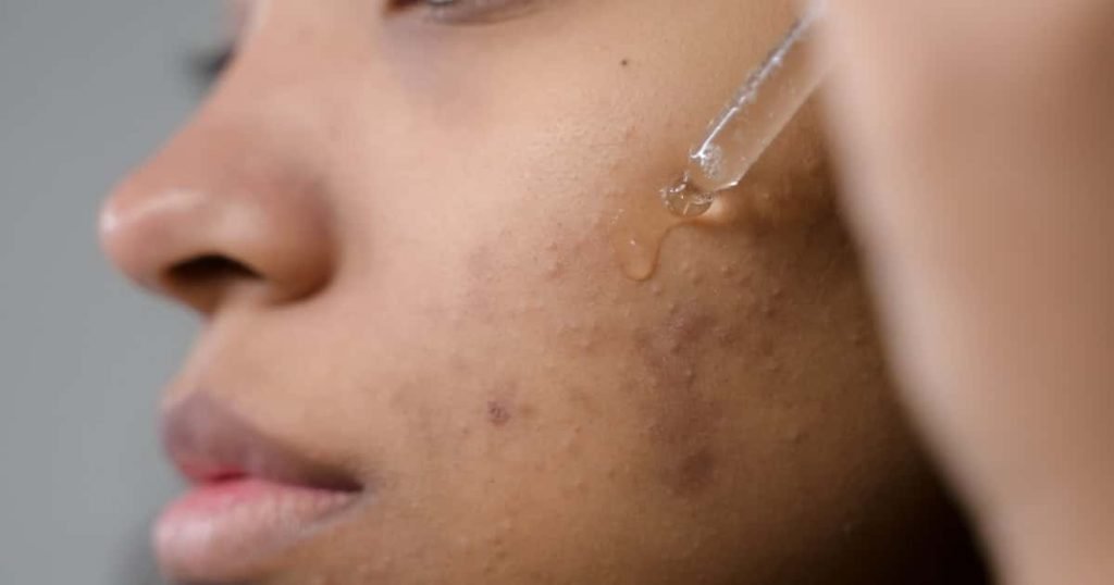 Treatment Options for Acne Scars