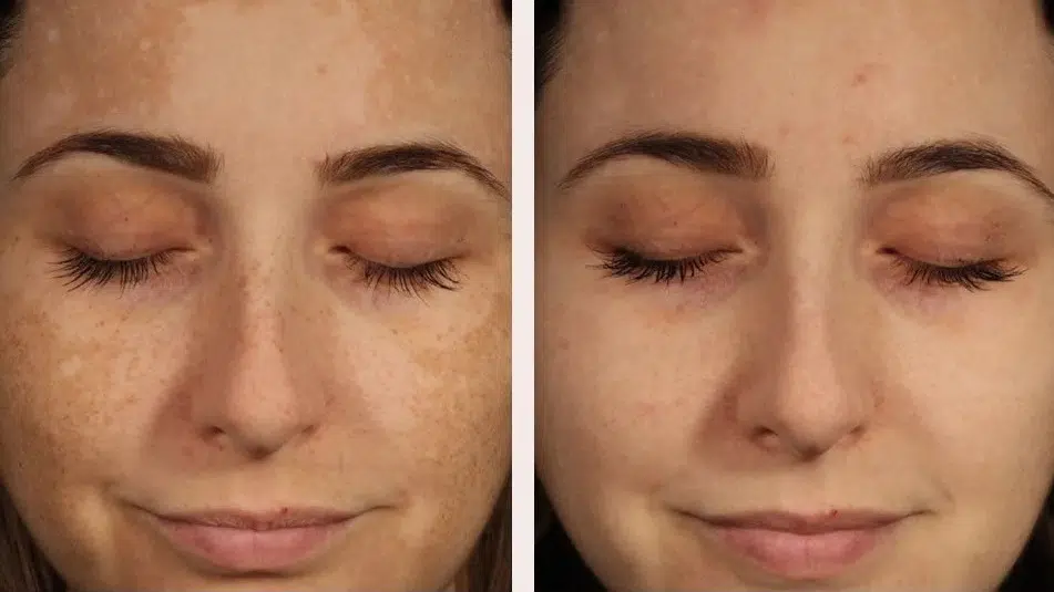 Anti pigmentation results