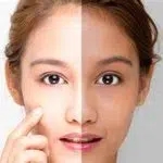 what is skin whitening