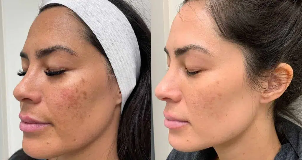 melasma serum treatment before and after